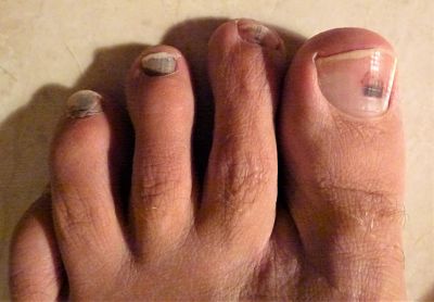Suffering with Toe Nails Runners Toe?